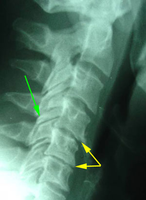 disc degeneration treated at Old Mill Chiropractic