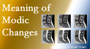 Old Mill Chiropractic sees many back pain and neck pain patients who bring their MRIs with them to the office. Modic changes are often seen.