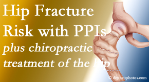 Old Mill Chiropractic shares new research describing increased risk of hip fracture with proton pump inhibitor use.