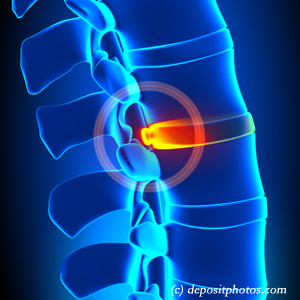 picture of lumbar St Peters disc herniation