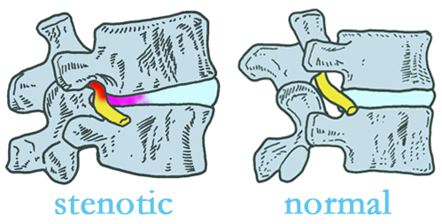 St Peters stenotic and normal spinal discs